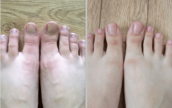 avant et après le traitement de la mycose des ongles des pieds