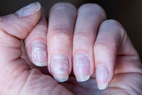 champignon sur les ongles