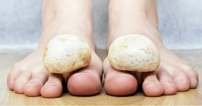Traitement rapide des champignons sur les jambes à la maison