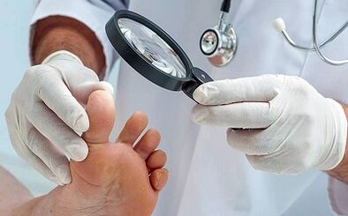 Comment se débarrasser de votre champignon de l'ongle