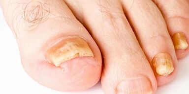 Comment et comment guérir les champignons de clou
