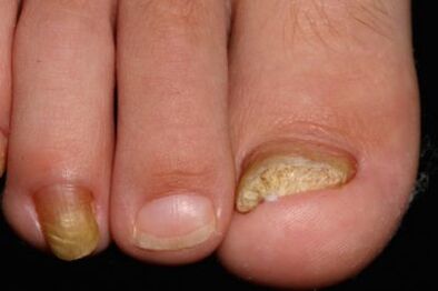 Micose des ongles sur les jambes
