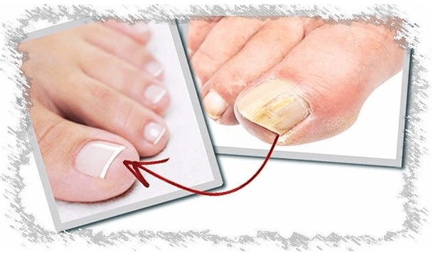 Causes de champignons à ongles