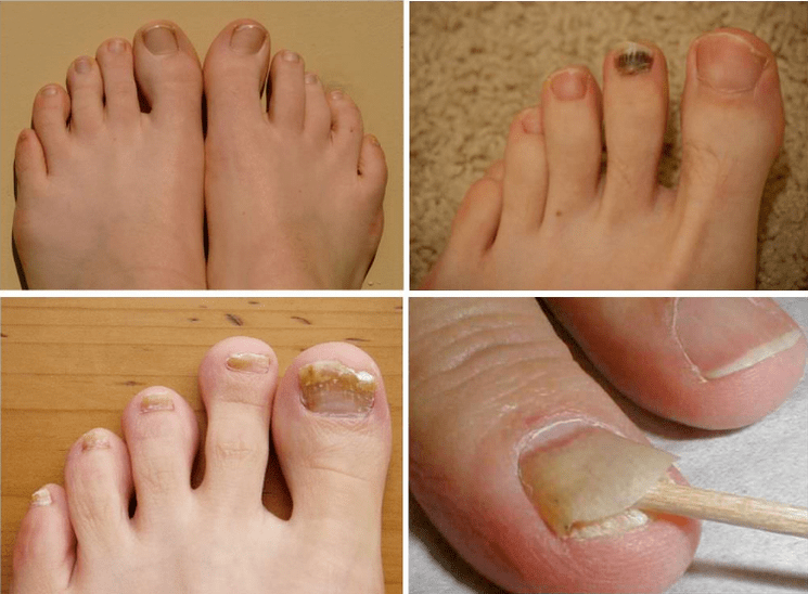 Signes de champignon d'ongles