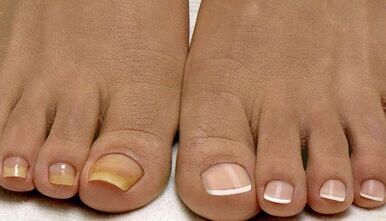 Les causes de l'apparence du champignon sur les ongles