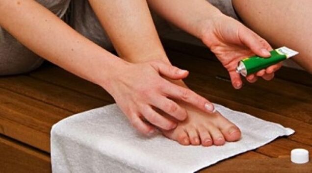 traitement de la mycose des ongles des pieds avec une pommade